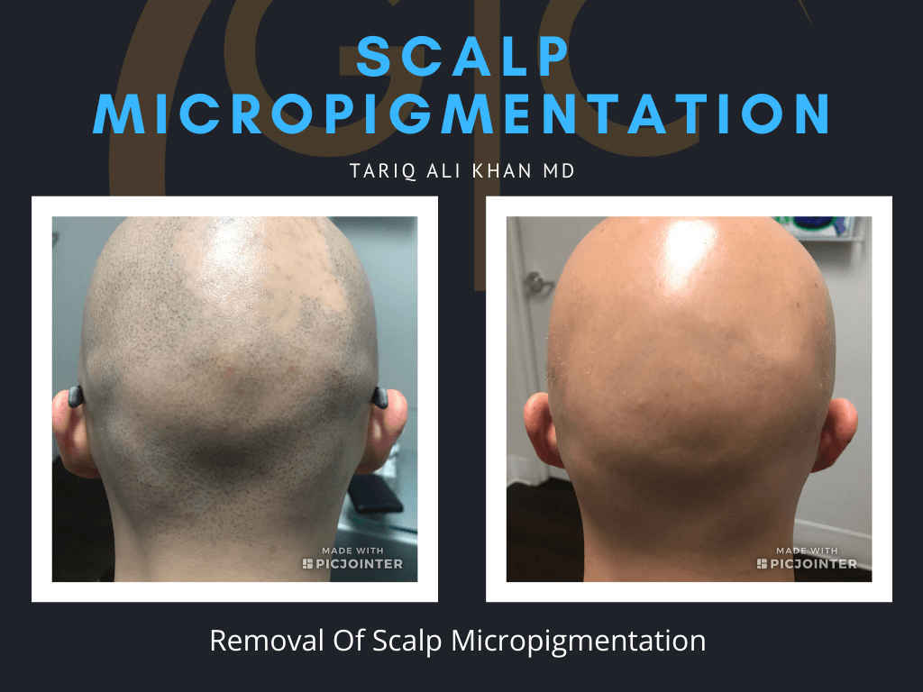 Gentle Care Laser Tustin Before and After picture - Scalp micropigmentation